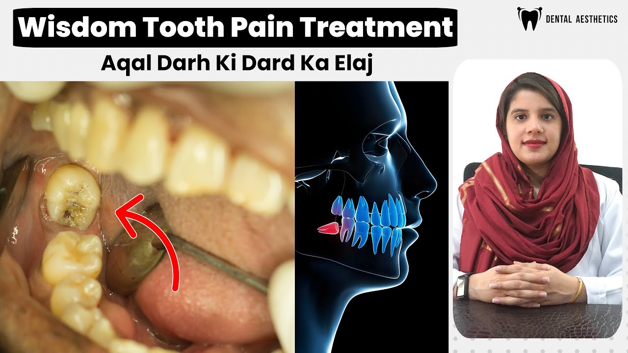 Wisdom Teeth Pain Treatments (Aqal Darh Ki Dard Ka Ilaj) | Why You Need Wisdom Tooth Extraction?