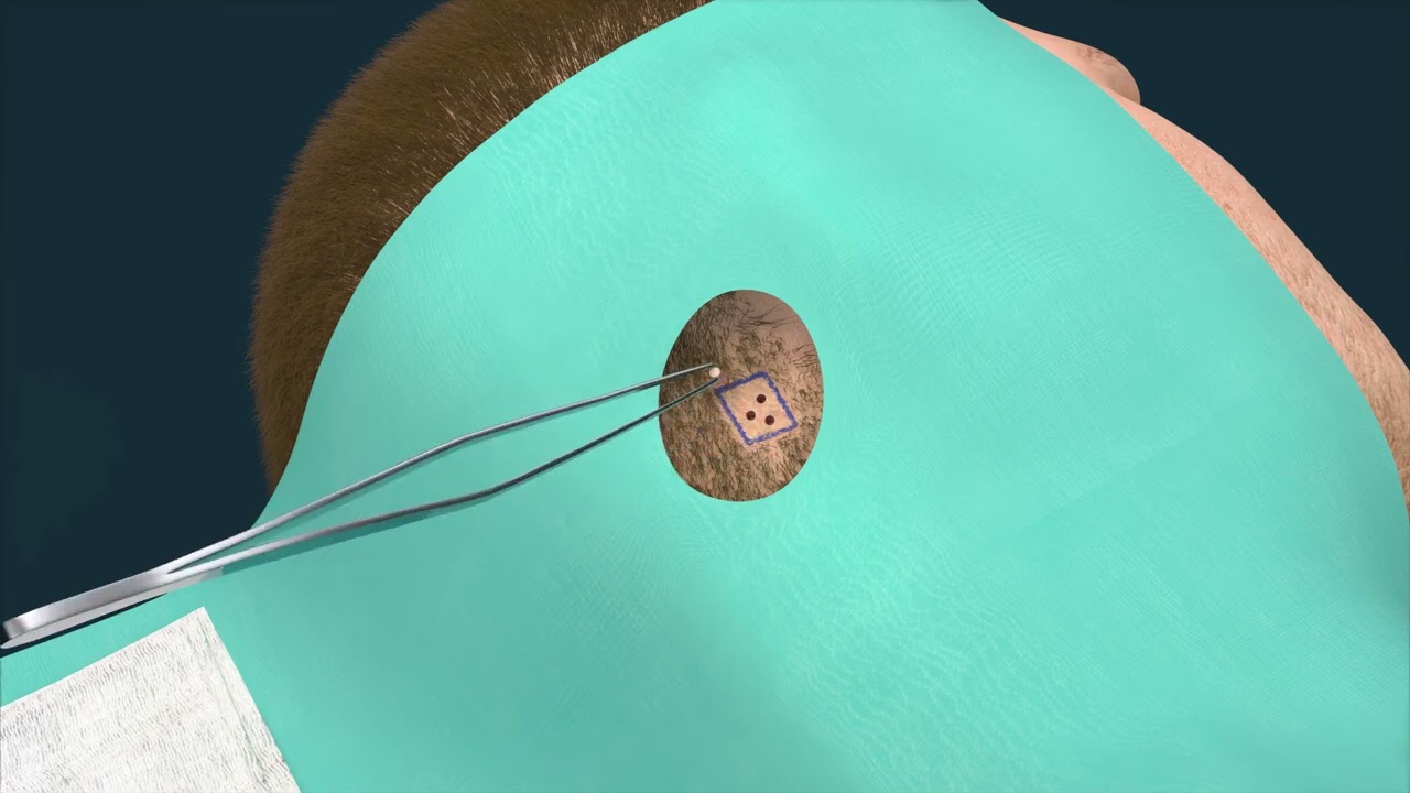 Step-by-Step Guide to Regenera Activa Treatment for Androgenetic Alopecia