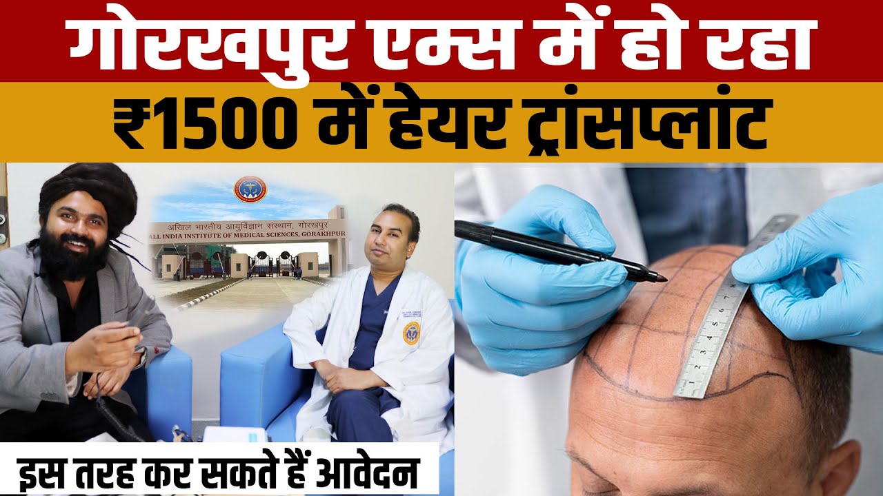 Gorakhpur Aiims Mein 1500 Mein Hair Transplant | गंजेपन से परेशान लोगों को   सस्ते हेयर ट्रांसप्लांट