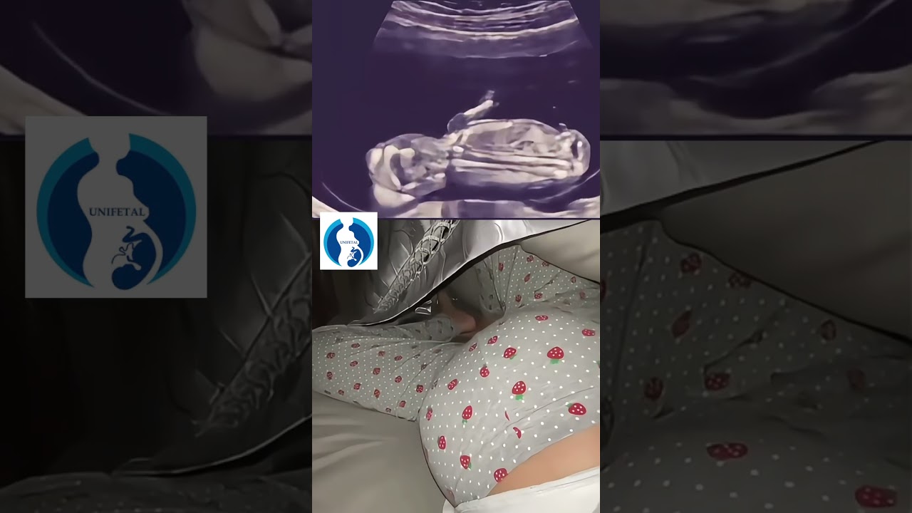 Movimientos fetales.  #fetal #perinatologia #maternofetal #embarazo #hijos #barranquilla #santamarta