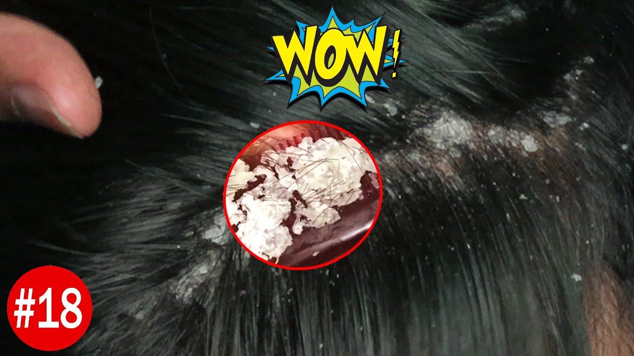 Dandruff Removal Satisfying | Big Flakes | Huge Flakes on Scalp | Ai Saito