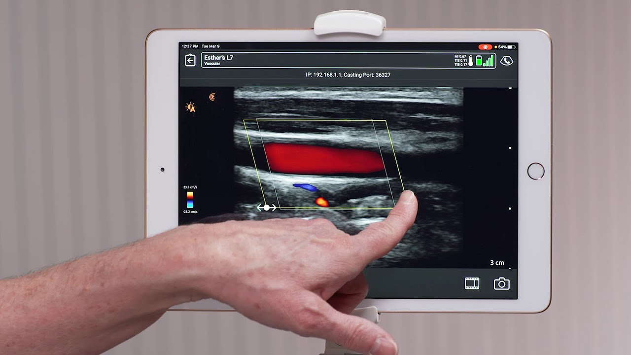 Clarius Feature: Color Doppler Mode