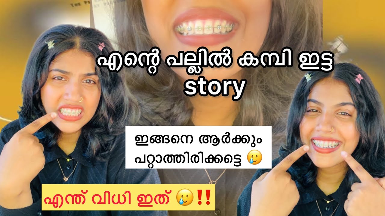 എന്റെ പല്ലിൽ കമ്പി ഇട്ട കഥ 😫എന്റെ വിധി അല്ലാതെ എന്ത് പറയാനാ 😡Dental braces journey
