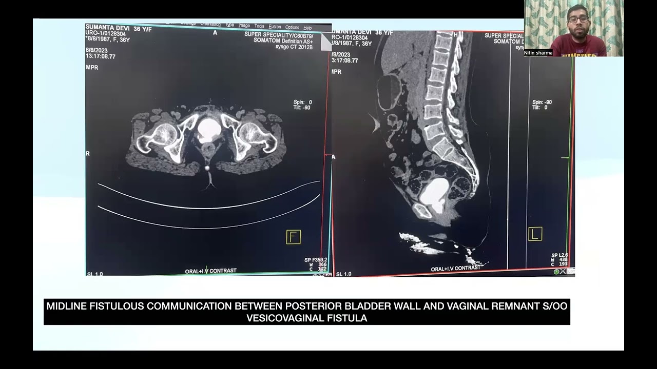 CTBUZZ2023- Papers: Dr Nitin Sharma: Value of CT Urography in Hematuria