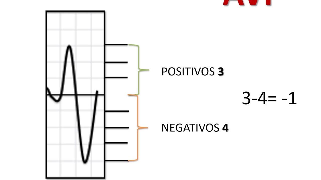 Cómo calcular el eje cardiaco