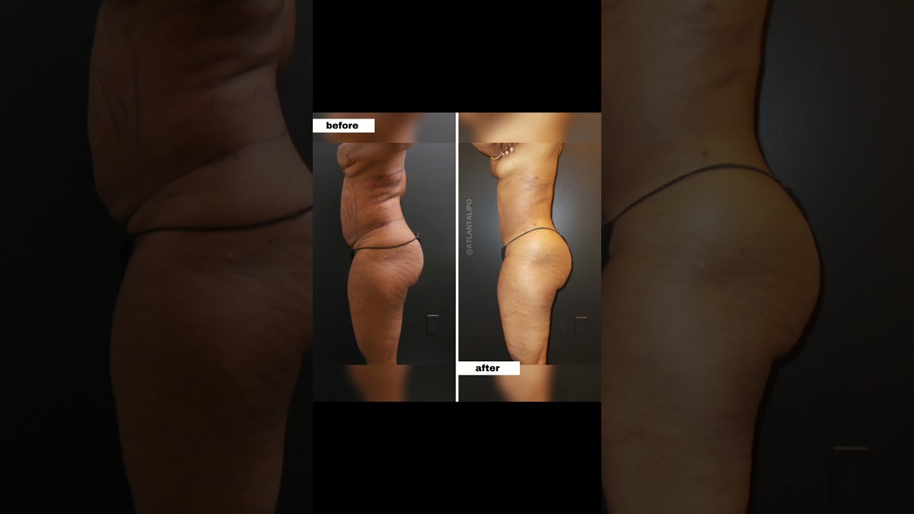 Lipo360 Testimonial- Atlanta Liposuction