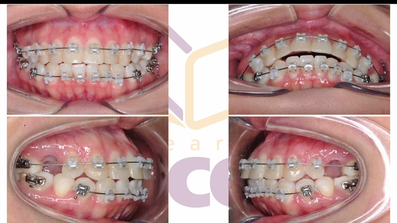 Manejo de casos con extracciones - LearnCCO