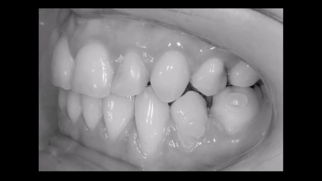 Appareil d'orthodontie linguale pour adolescent