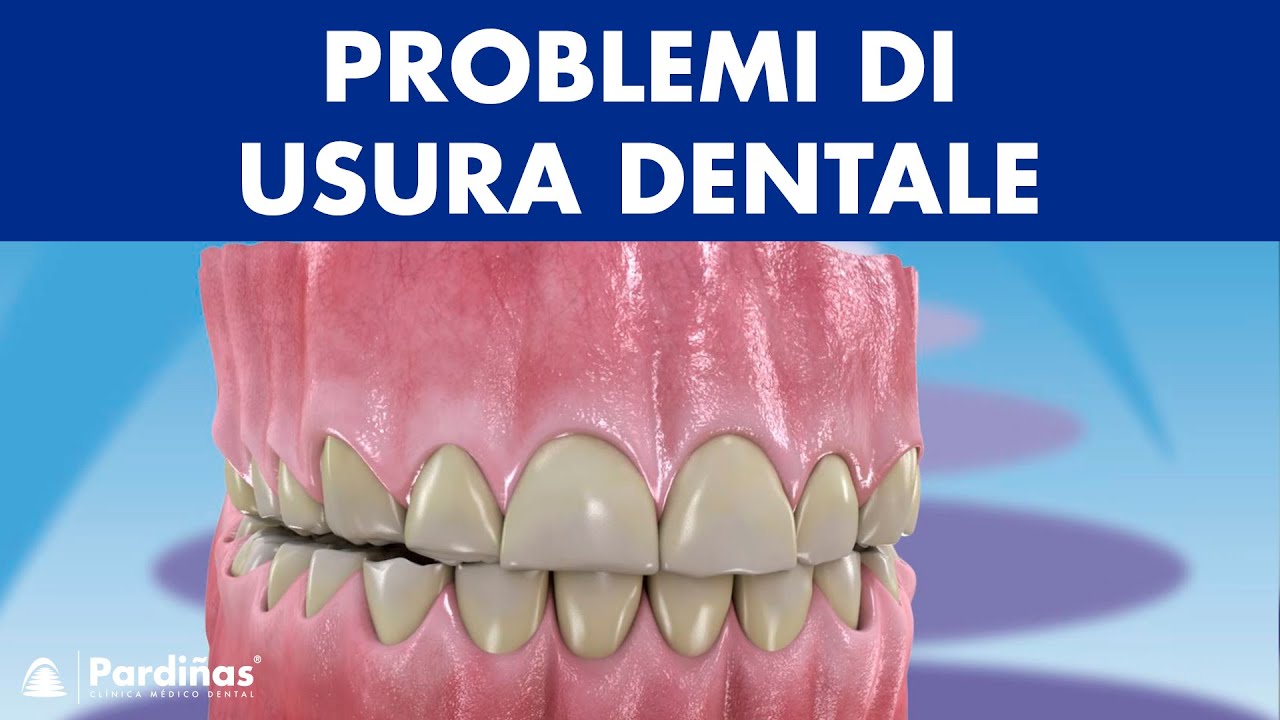 EROSIONE smalto denti, ABRASIONE dentale, ABFRAZIONE e altri problemi di usura ©