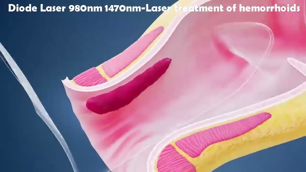 Laser Hemorrhoidoplasty LHP