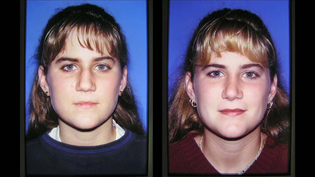 NASHVILLE NASAL (RHINOPLASTY) PLASTIC SURGERY BEFORE AND AFTER