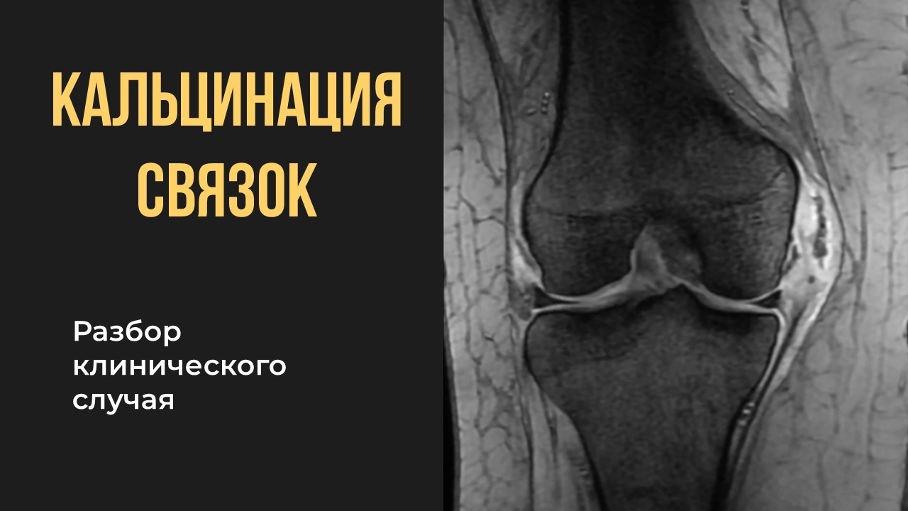 Кальцинация связок коленного сустава на МРТ. Разбор случая