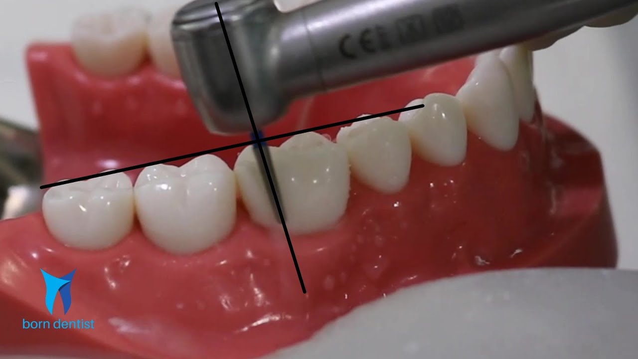 TOOTH PREPARATION FOR ZIRCONIA CROWN