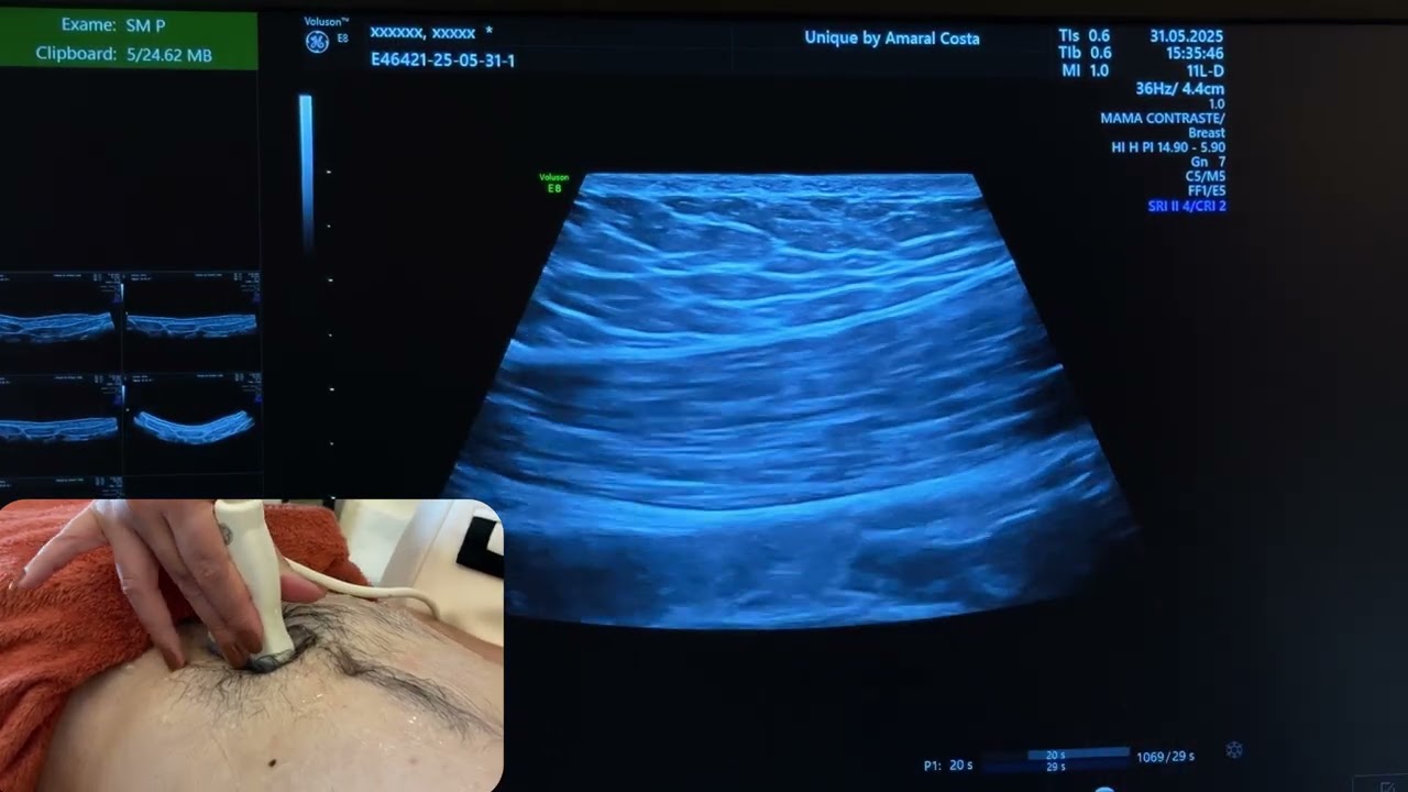 US Parede Abdominal - Demonstração Prática - masculino