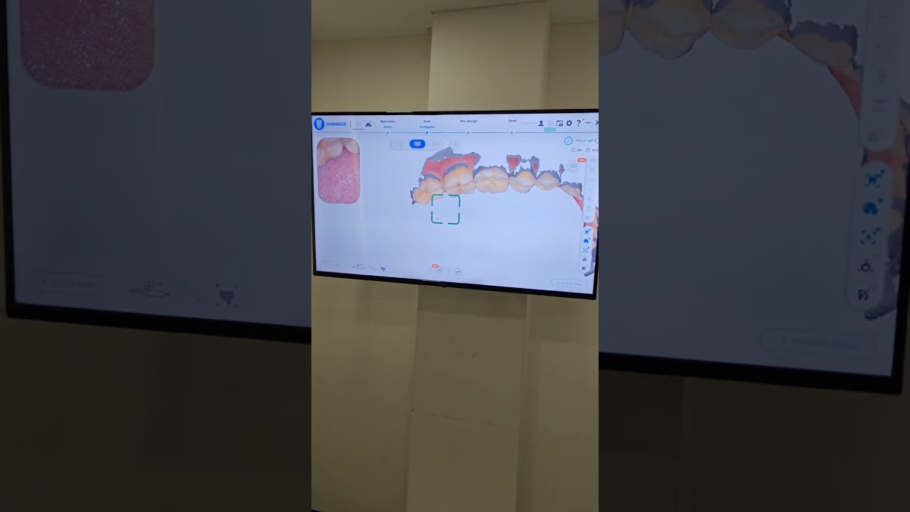 Review of Aoral Scan 3 by Shining 3D