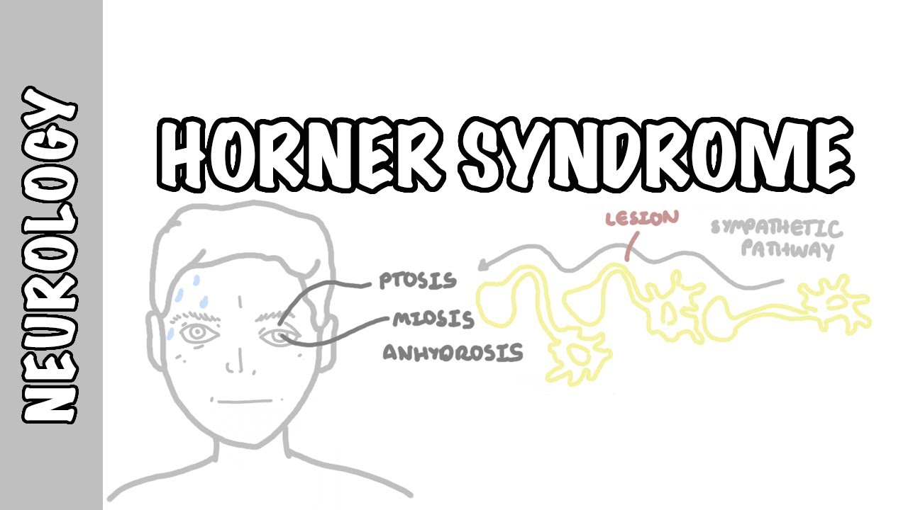 Horner Syndrome - anatomy, causes, pathophysiology, investigation