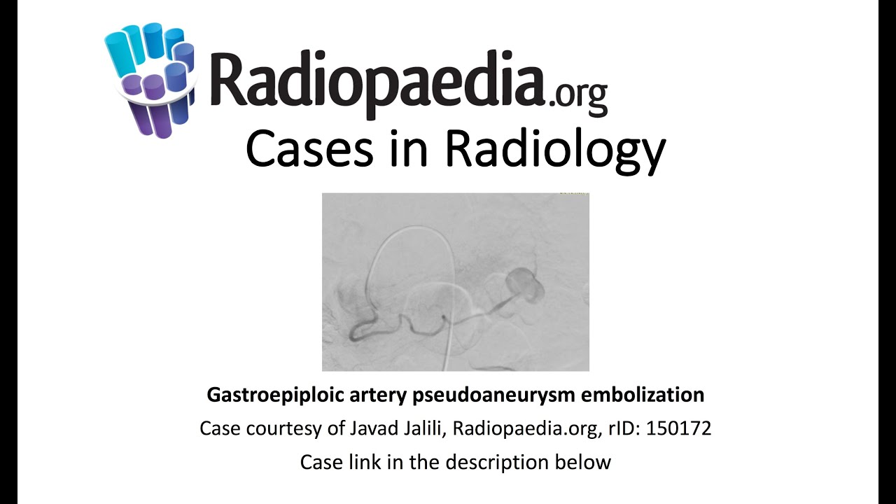 Gastroepiploic artery pseudoaneurysm embolization (Radiopaedia.org) Cases in Radiology