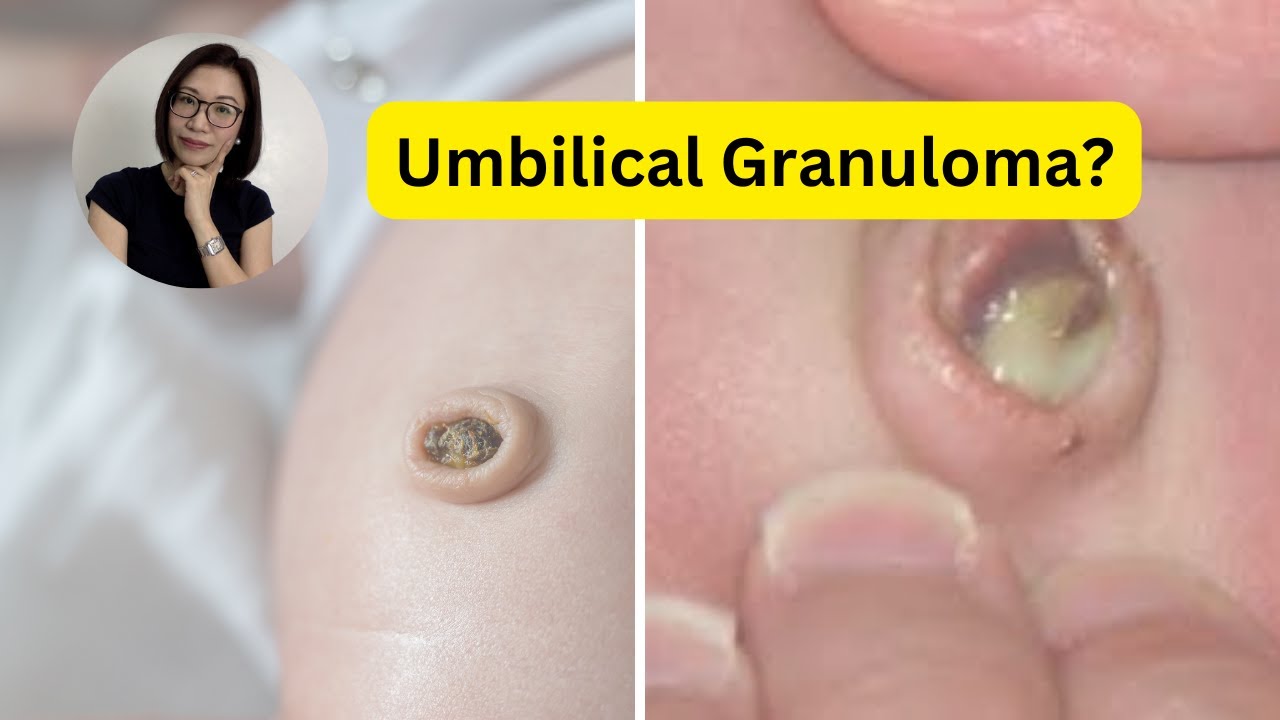 Umbilical Granuloma: Treatment and Taking care of baby's umbilical cord | Dr. Kristine Alba Kiat