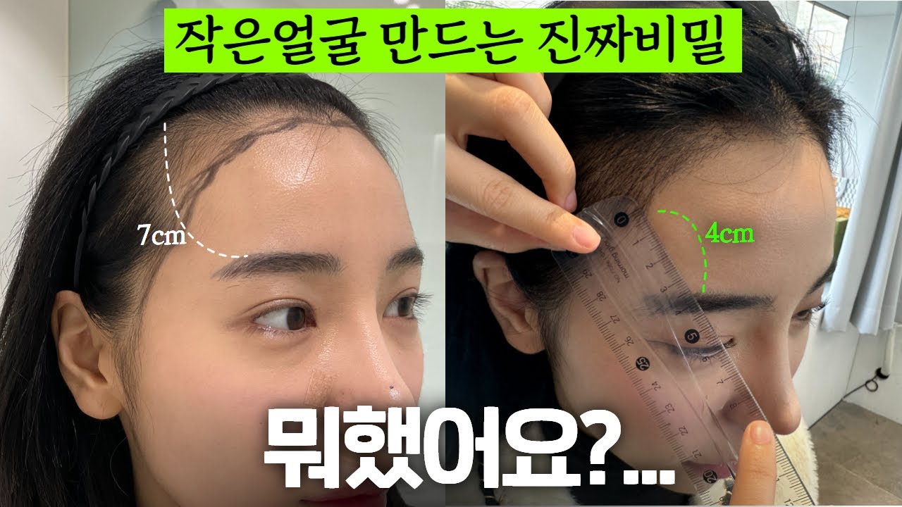 친구들이 도대체 뭐했냐고 계속 물어봐요! ㅎㅎ | 여자 헤어라인 모발이식 | 수술전~ 2주차 풀공개!!!