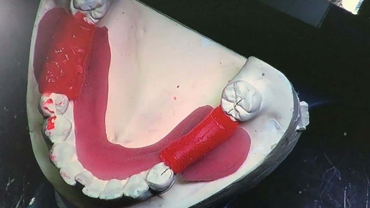 441.20A Montage des dents postérieures superieures