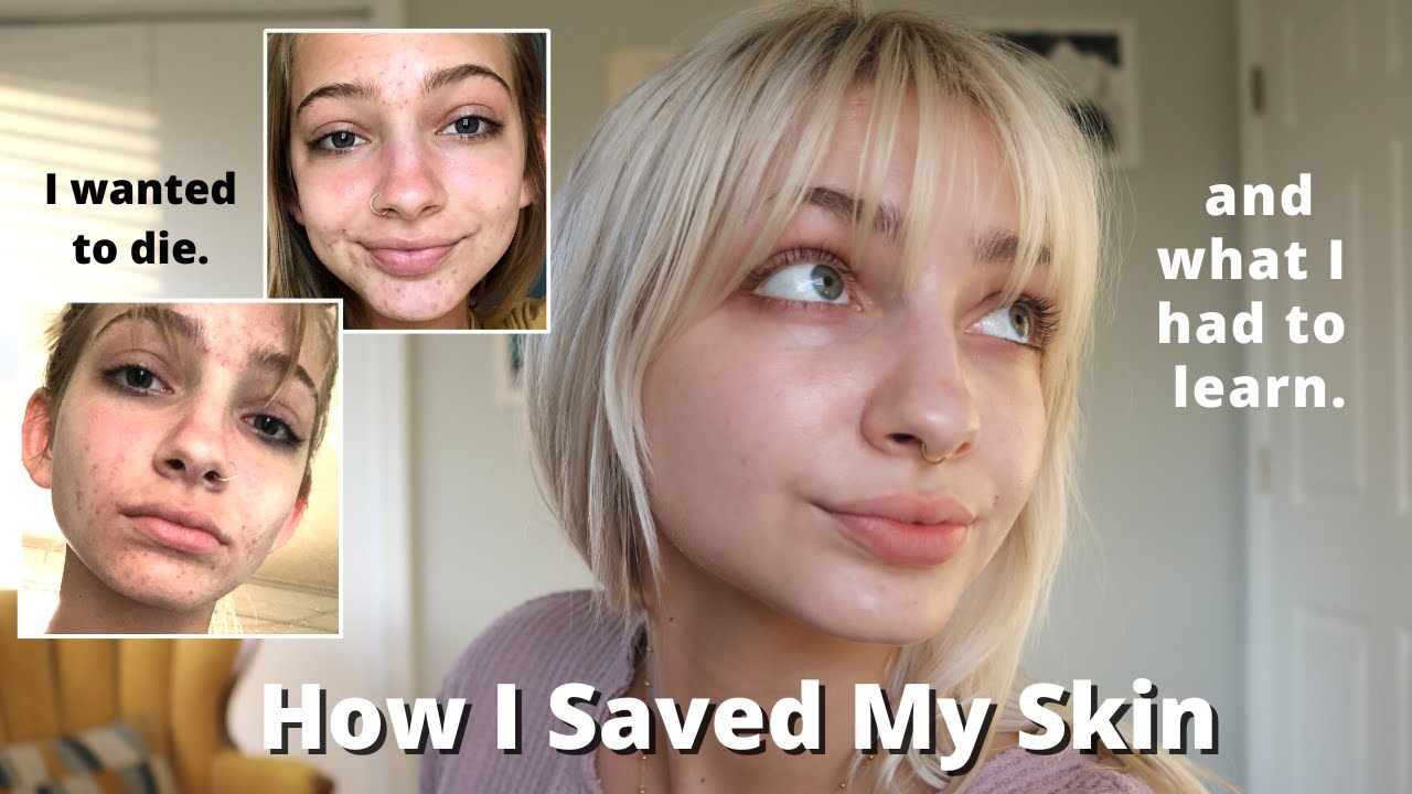 How I ACTUALLY Cleared My Skin
