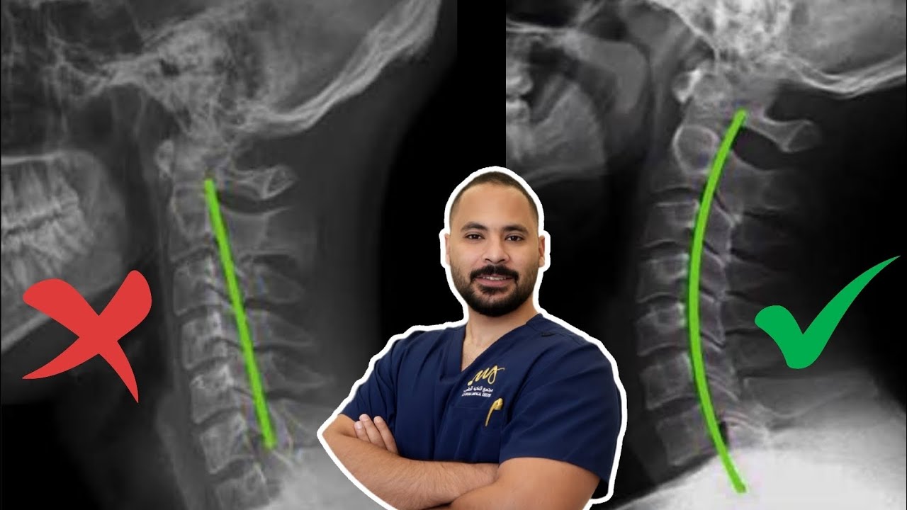 علاج استقامة الرقبة(الأسباب ، الأعراض ، العلاج ) الحل النهائي!!