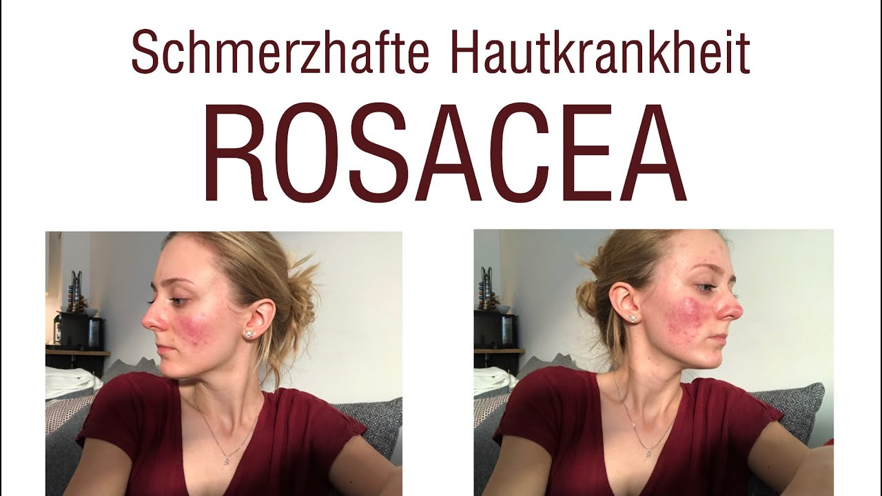 Wie ich meine Rosacea geheilt habe! - Laser-Therapie
