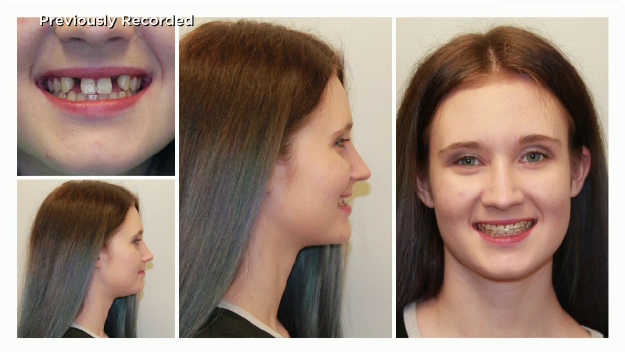 Dr  Lugakingira, Missing Lateral Incisors Dental Implants, WPTA ABC 21