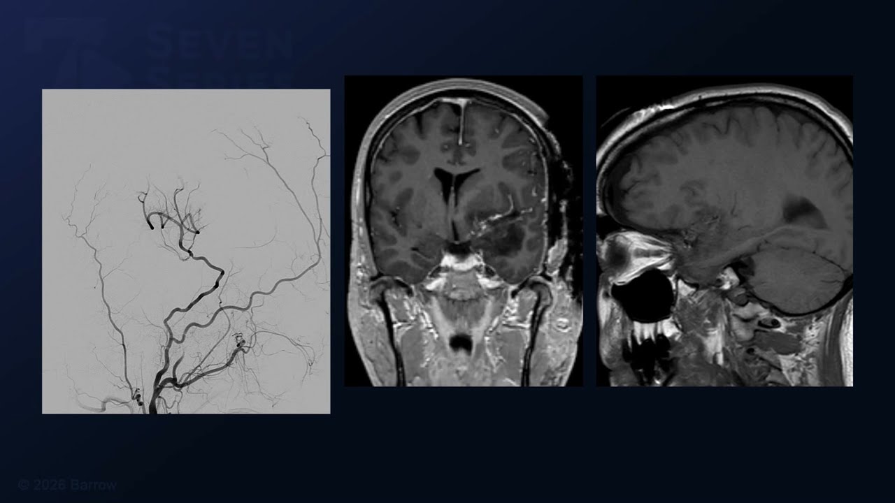 Pterional Craniotomy and EAC for Resection of a Clinoidal Meningioma with STA-MCA Bypass