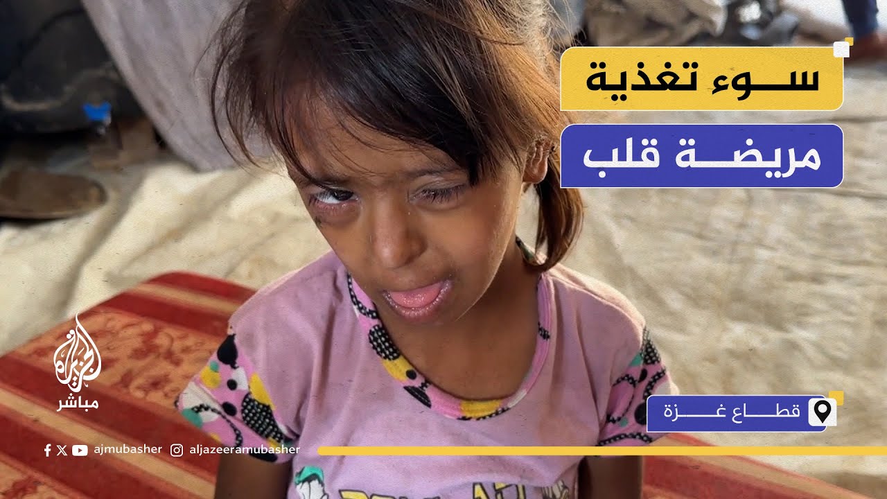 طفلة نازحة مريضة قلب تفقد نصف وزنها بسبب المجاعة