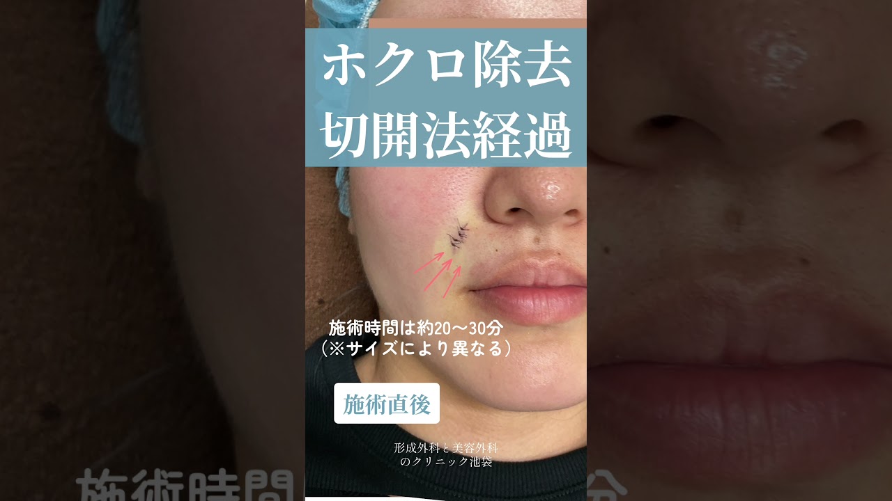 ホクロ除去切開法の経過【形成外科専門医執刀】 #整形 #垢抜け #令和の虎