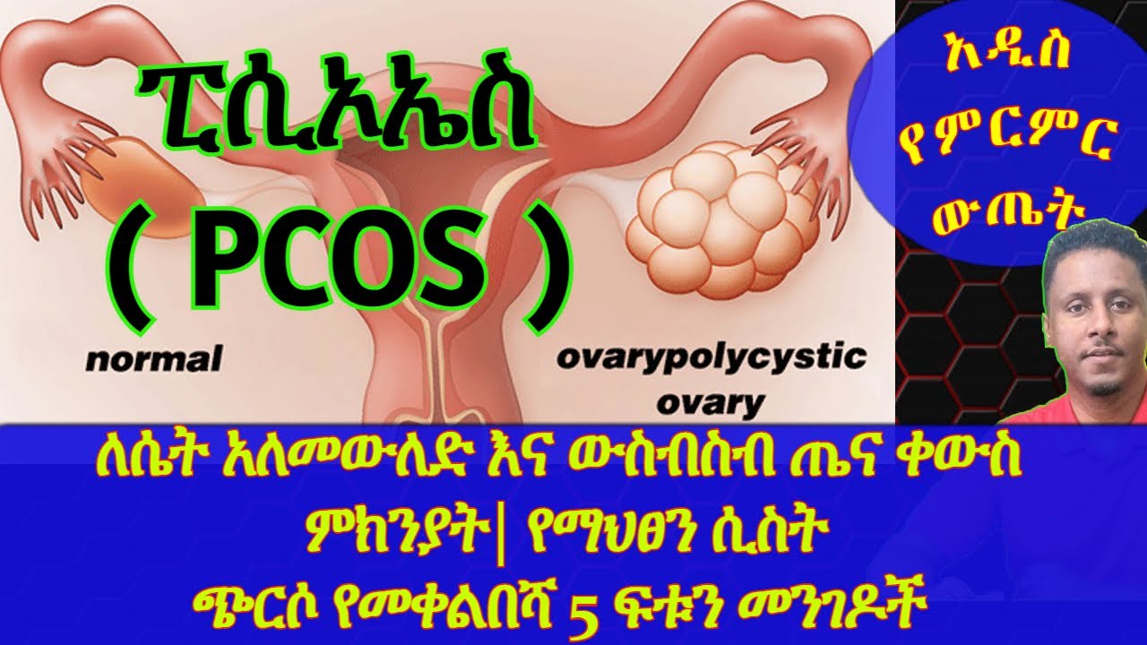 Ethiopia | ለሴት አለመውለድ እና ውስብስብ ጤና ቀውስ ምክንያት የሆነውን ጭርሶ የመቀልበሻ 5 ፍቱን መንገዶች | ፒሲኦኤስ( PCOS )