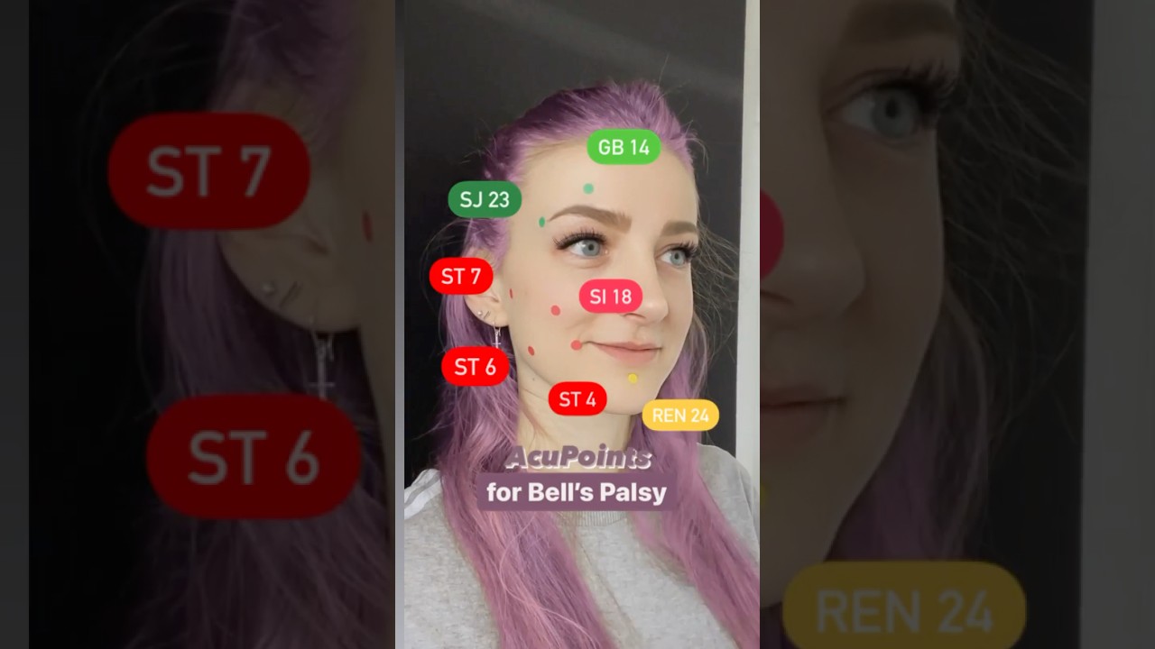 Acupuncture Points for Bell&rsquo;s Palsy 🥴