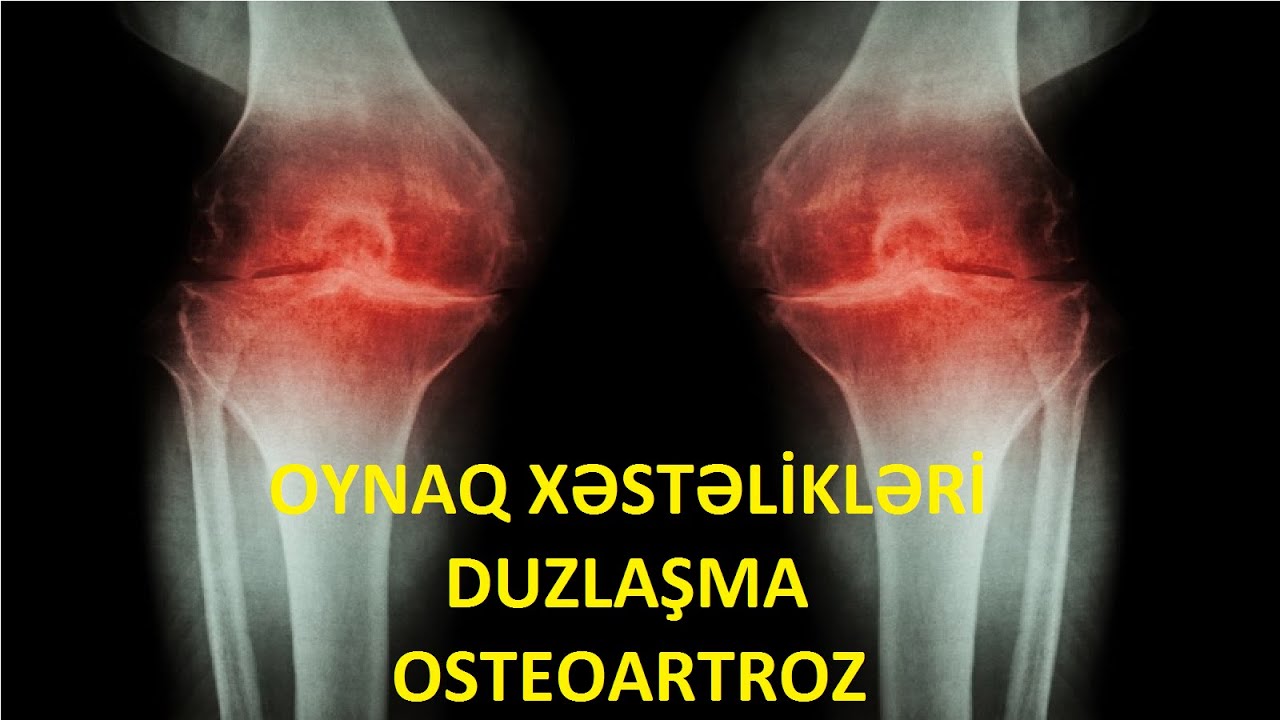 Oynaq Xəstəlikləri (Duzlaşma) Osteoartroz Zamanı Xalq Təbabəti