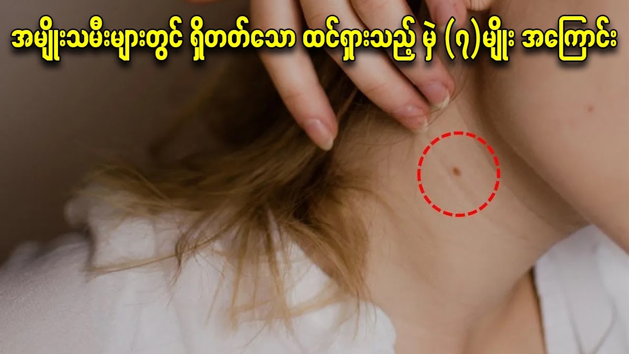 အမျိုးသမီးများတွင် ရှိတတ်သော ထင်ရှားသည့် မှဲ (၇)မျိုး အကြောင်း