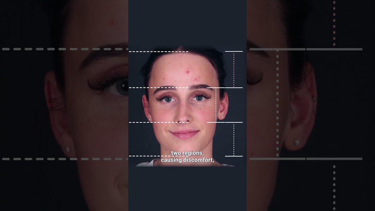 Everything About Forehead Reduction
