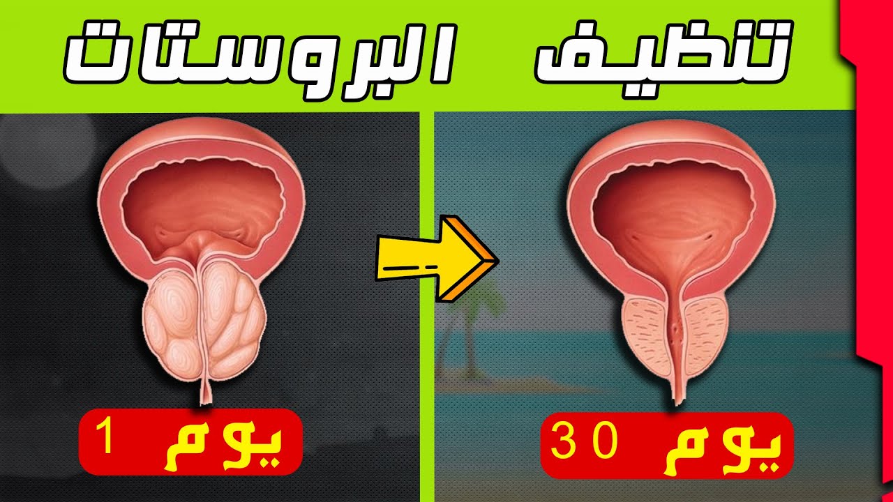 الطريقة الوحيدة بعد فشل الادوية. وصفه تعيد البروستات للشباب | علاج كثره التبول والم البول والسلس