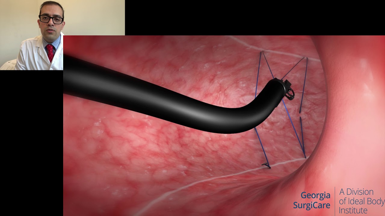 Endoscopic Sleeve Gastroplasty aka ESG procedure for weight loss