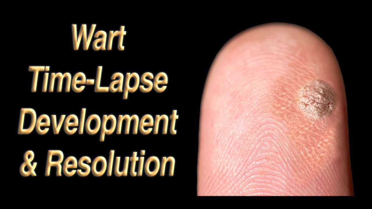 Wart Development & Resolution Time Lapse