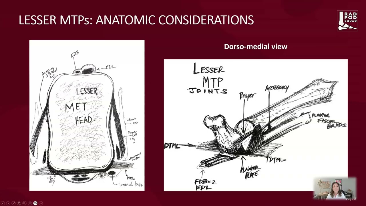 Normal Anatomy in the Plantar Plate | RadPodSquad Plantar Plate Imaging
