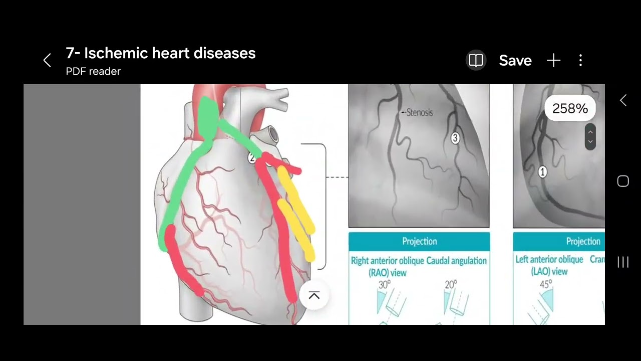 Ischemic Heart Diseases 