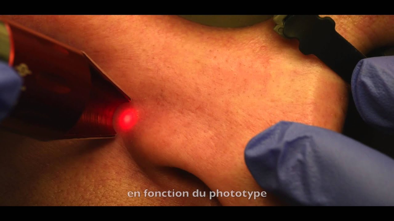 K Laser Blue Derma