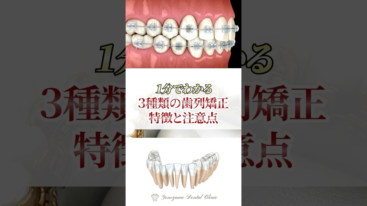 歯列矯正3種類の特徴と注意点#矯正歯科 #歯列矯正 #徳島歯医者 #歯医者