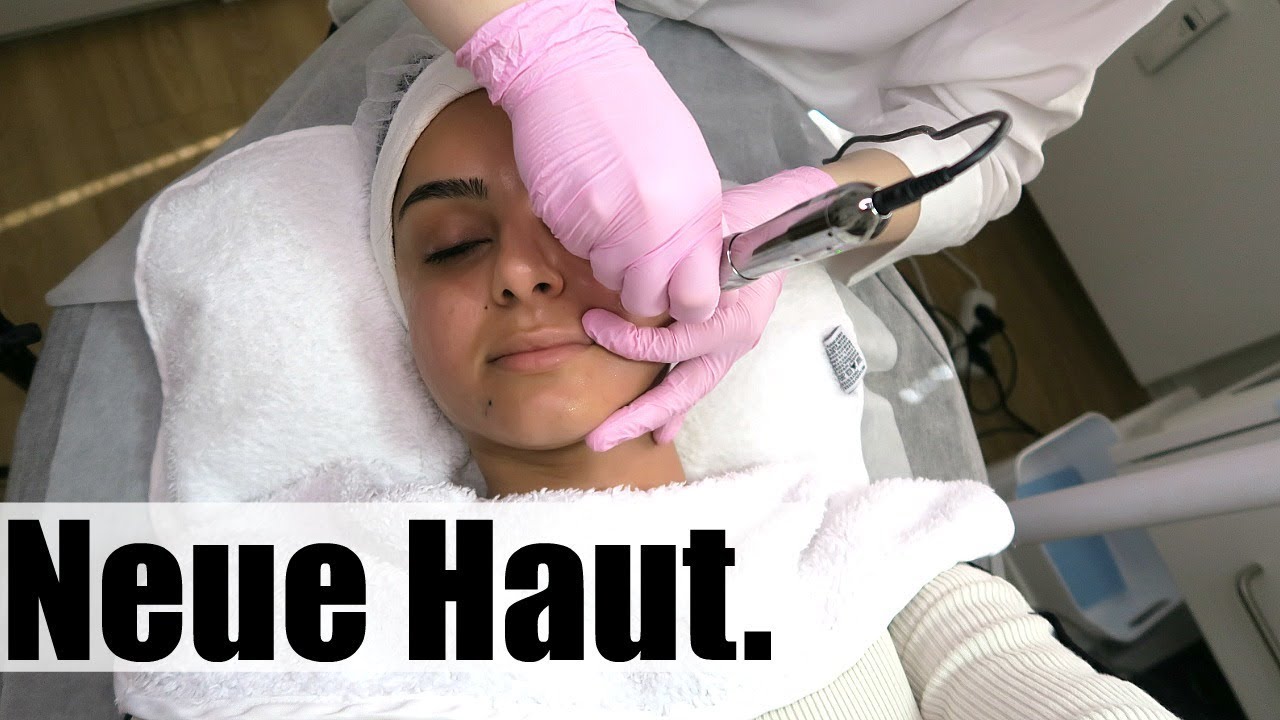 Pickel-Narben, Akne-Narben, SCHNELL verschwinden lassen 💉! MICRONEEDELING Im Test! Tamtambeauty