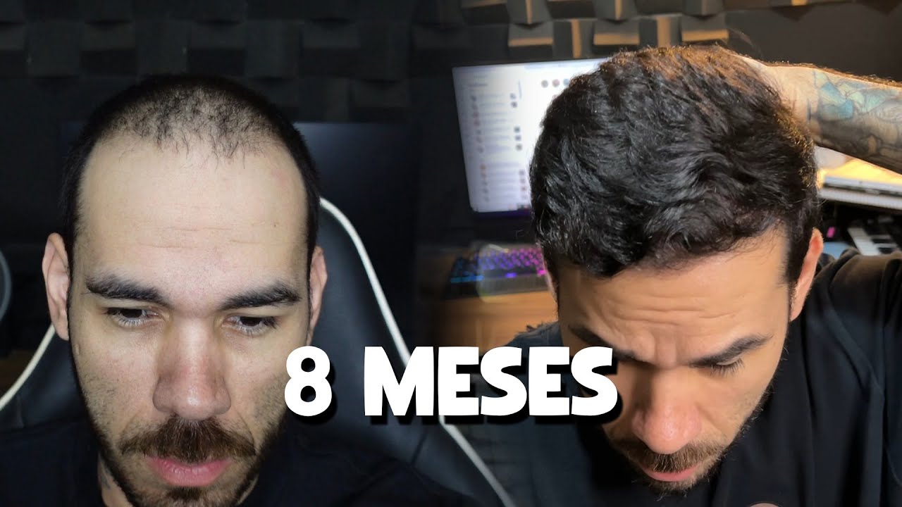 RESULTADO DE 8 MESES APÓS TRANSPLANTE CAPILAR
