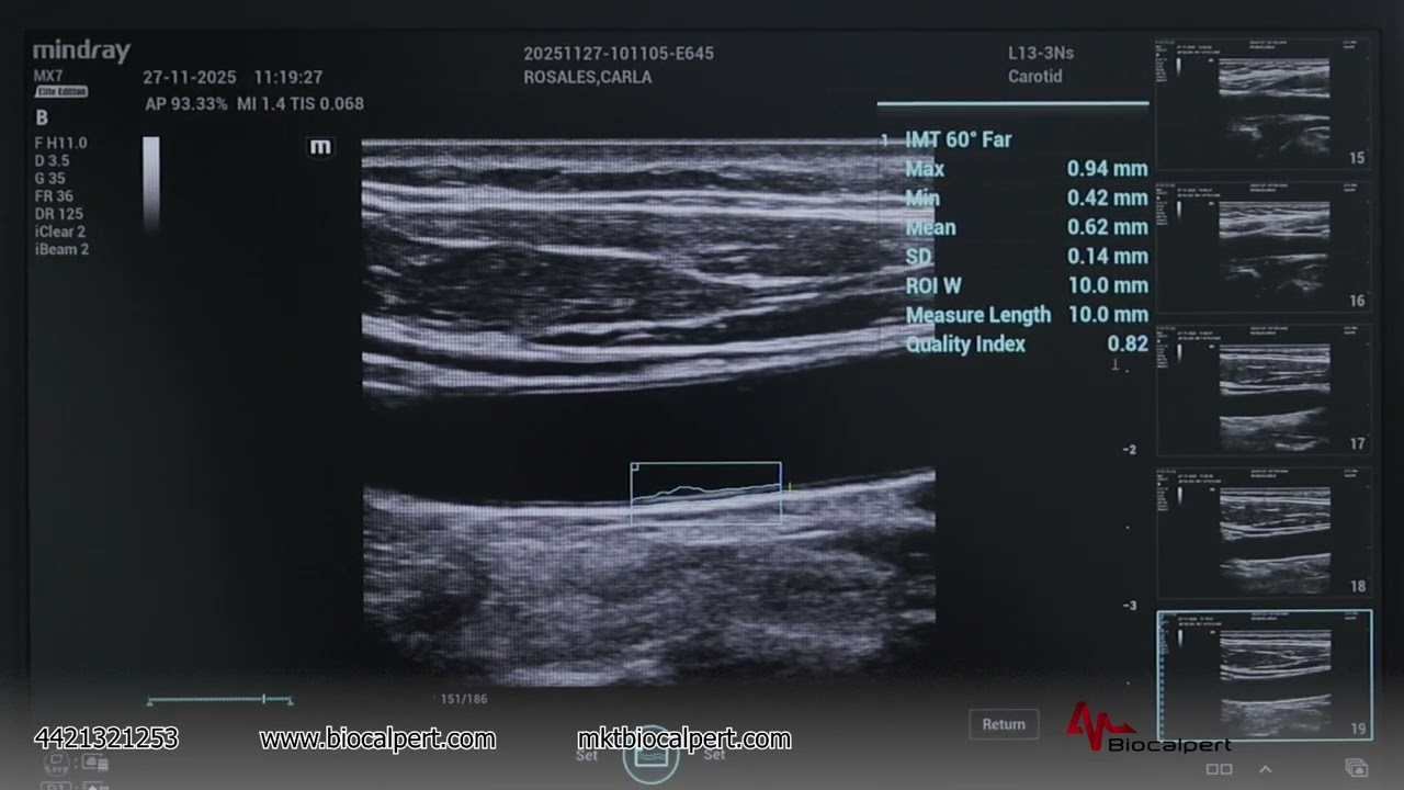 Medición Automática del espesor de la íntima media (Auto IMT) en el ultrasonido Mindray MX7