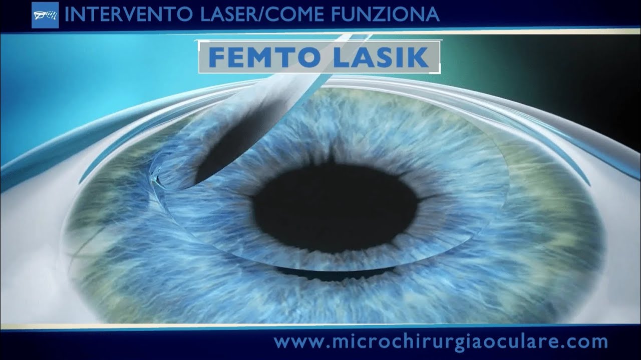 Mi sono operata agli occhi! La mia esperienza con FemtoLasik
