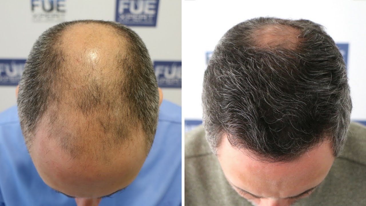 FUE Hair Transplant (3268 Grafts in NW V-VI) Dr. Juan Couto - FUEXPERT CLINIC- Madrid, Spain