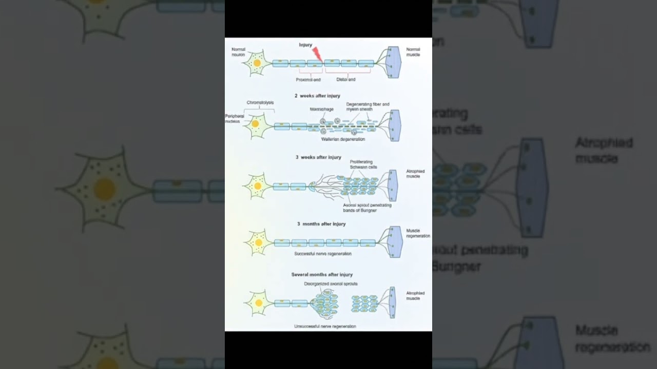 Stages of Peripheral Nerve Injury and Regeneration 