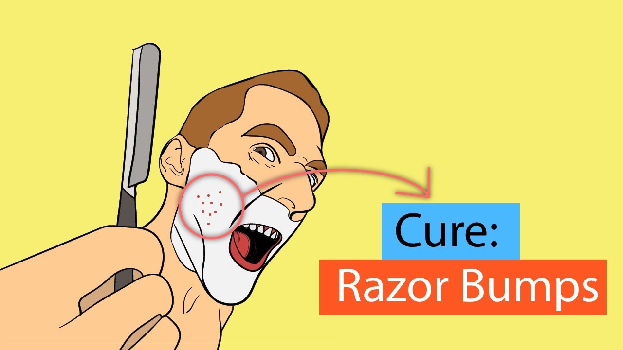 9 Fastest Ways to Get Rid of Razor Bumps